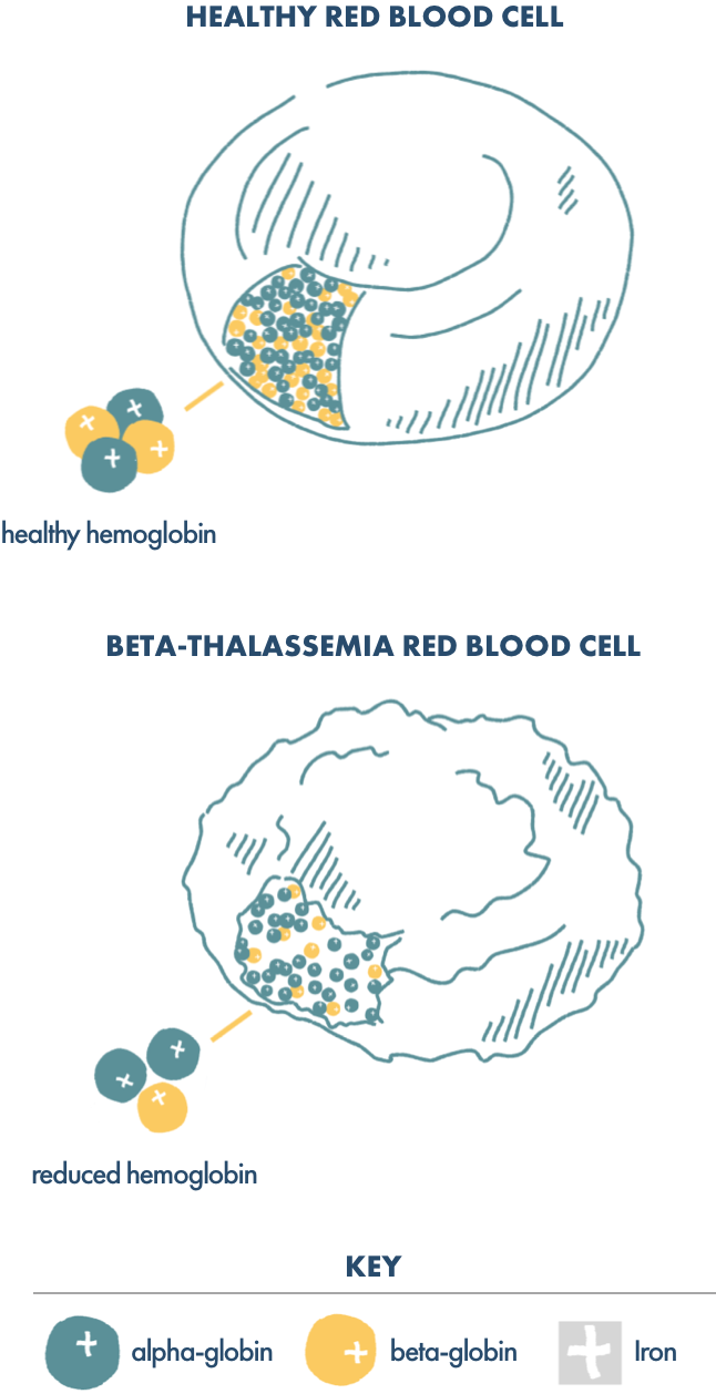 Illustration of a healthy red blood cell vs. a beta thalassemia red blood cell